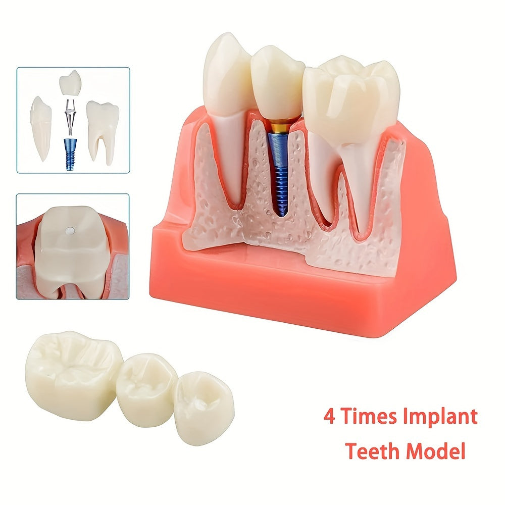 Съемная модель зубного имплантата с 4 коронковыми мостами, PVC материал для образования и изучения
