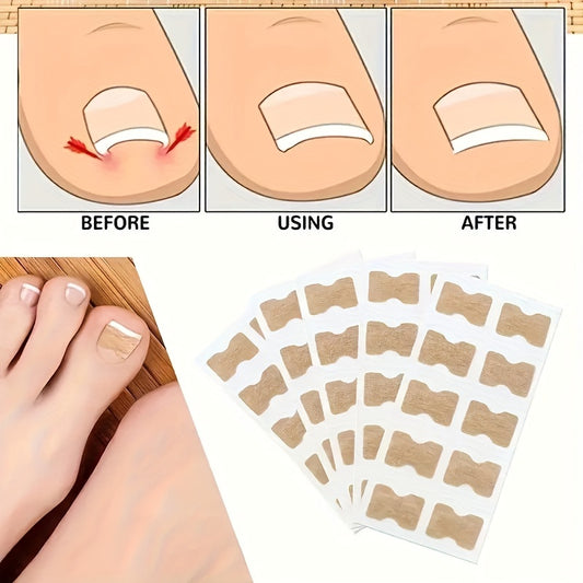 Toe Nails Correctors in packs of 50/100/200