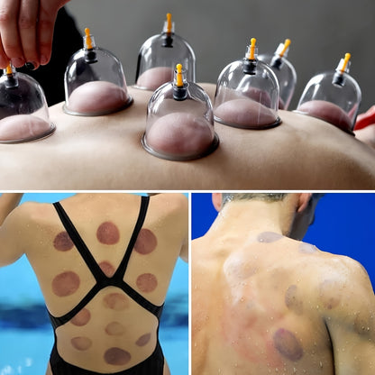 Massage Cupping Set with multiple vacuum cups, hand pump, and detailed manual for massage therapists and Chinese acupuncture. Portable with vacuum suction.