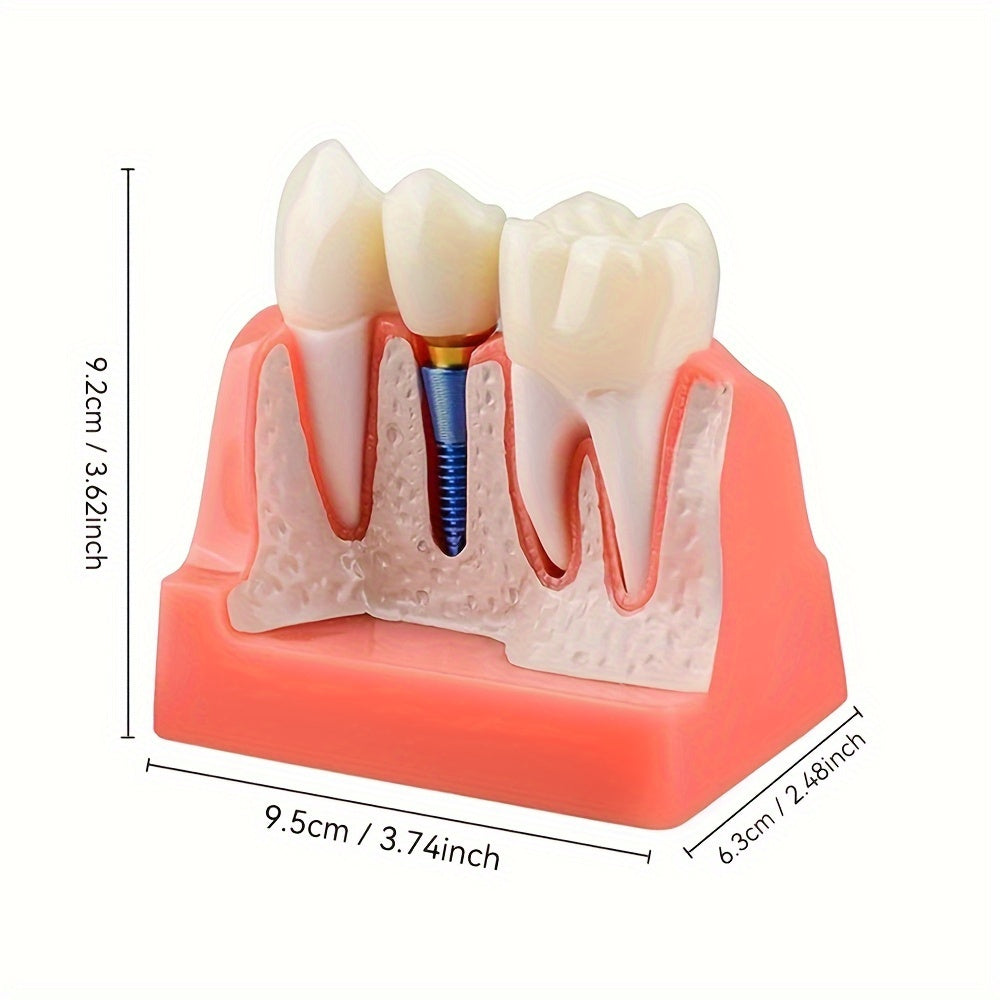 Съемная модель зубного имплантата с 4 коронковыми мостами, PVC материал для образования и изучения